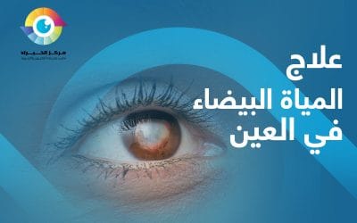 هل يمكن علاج المياه البيضاء في العين باستخدام القطرات؟