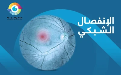 أهم ما تحتاج إلى معرفته عن الانفصال الشبكي