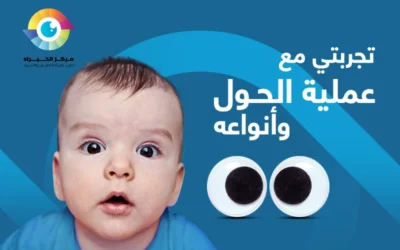 تجربتي مع عملية الحول | وتعليمات الطبيب؟