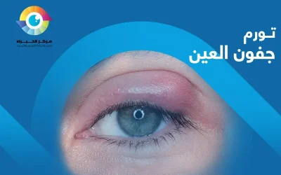 هل تورم جفون العين خطير؟ وما وسائل علاجه؟ 