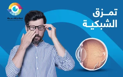 التعرف إلى أعراض تمزق الشبكية مبكرًا يمهد لك سبل العلاج