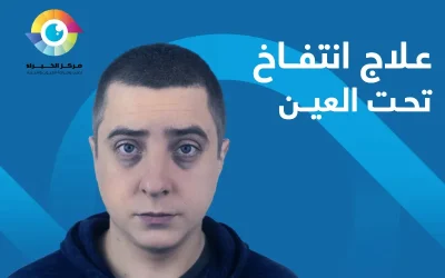 علاج انتفاخ تحت العين: الأسباب والحلول الفعالة 100%