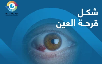 شكل قرحة العين وعلاجها