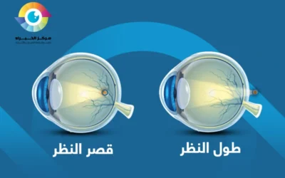 دليلك الشامل عن قصر النظر وطول النظر