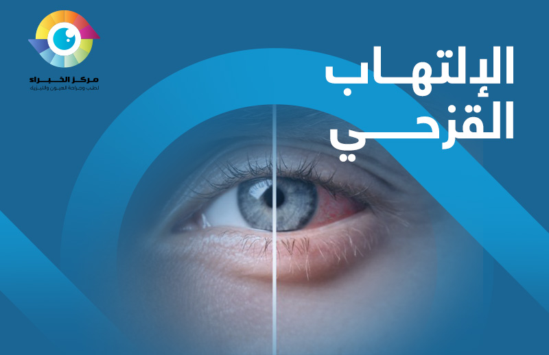 الالتهاب القزحي