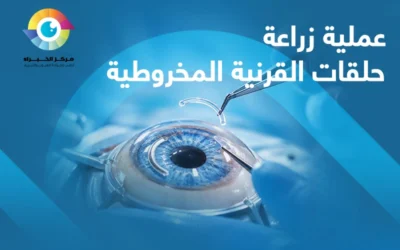 عملية زراعة حلقات القرنية المخروطية | خيار فعّال يُحسن رؤيتك